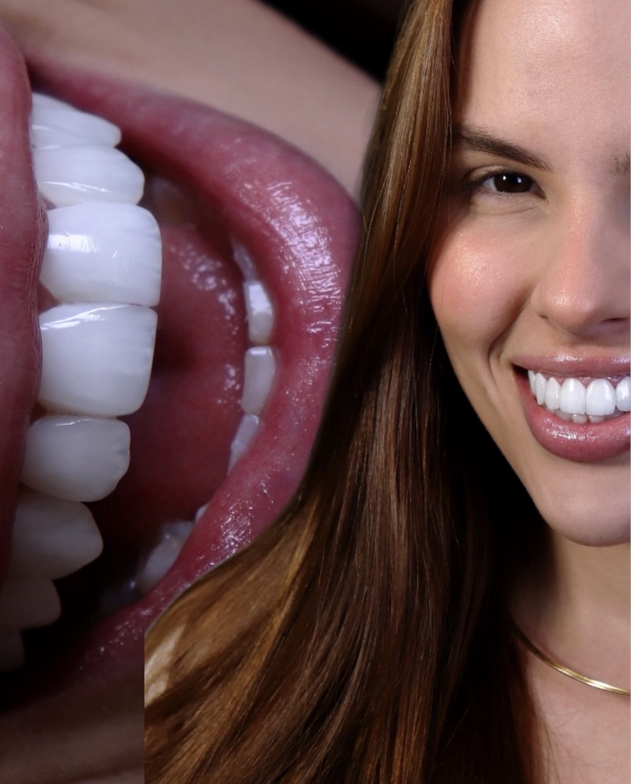 Close-up de um sorriso finalizado com lentes em resina composta
