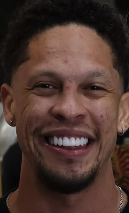 Depois das lentes em resina composta